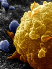 Tecnologia desenvolvida com nanopartículas reduz os efeitos da quimioterapia sobre células saudáveis